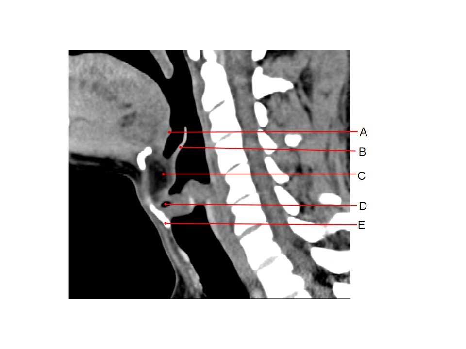 颈部ct横断面解剖图谱图片